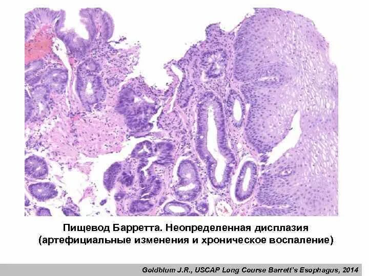 Пищевод барретта отзывы. Гистология при пищеводе Барретта. Морфологическая картина пищевода Барретта что это. Пищевод Барретта гистология. Дисплазия слизистой желудка гистология.