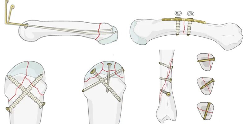 Остеосинтез операция пластины. Остеосинтез перелома 5 пястной кости. Перелом надколенника остеосинтез. Остеосинтез плечевой кости пластиной. Остеосинтез 1 пястной кости.