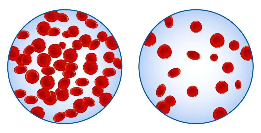 Малокровие эритроцитов. Эритроциты. Нормальные эритроциты. Нормальная концентрация эритроцитов.