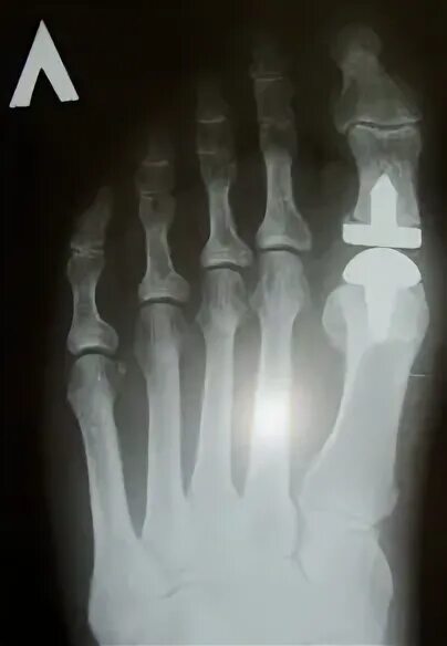 Эндопротезирование сустава стопы. Тэп голеностопного сустава. Эндопротезирование 1 плюснефалангового сустава. Эндопротезирование сустава стопы. Артродез 1 плюснефалангового сустава.