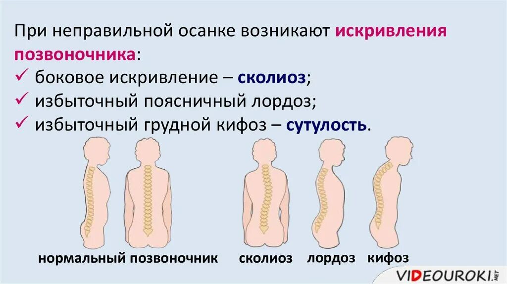 Нарушение осанки кифоз сколиоз. Нарушение осанки лордоз кифоз сколиоз. Деформации позвоночника кифоз лордоз сколиоз. Таблица лордоз кифоз сколиоз. В процессе эволюции позвоночник появился у