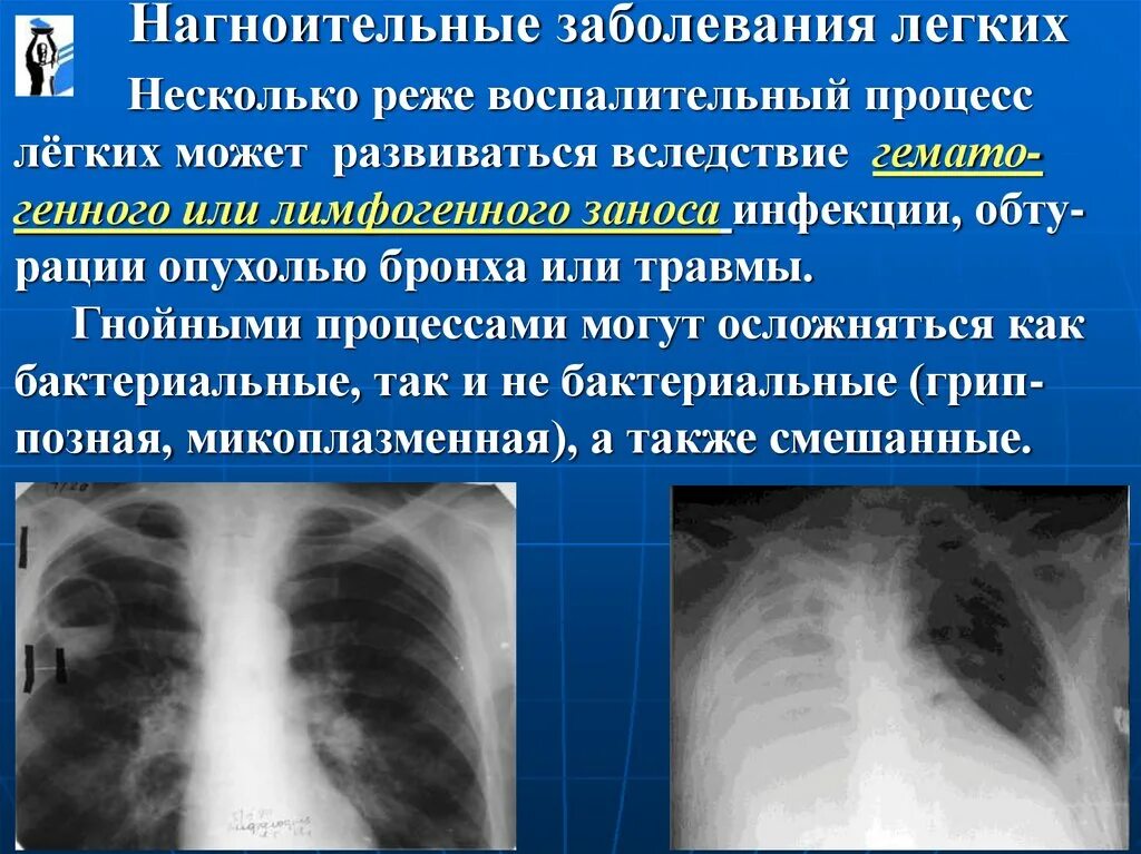 Легкая форма поражения легких. Нагноительные заболевания легких. Нагноительные процессы в легких. Воспалительный процесс в легких. Хронические нагноительные заболевания легких.