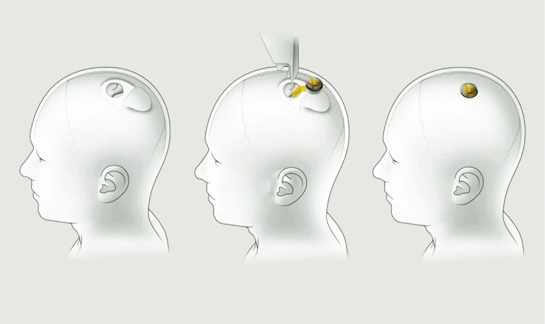 Маск вживил чип в мозг. Neuralink Илон Маск. Нейрочип Neuralink. Neuralink 2022 нейрочип.