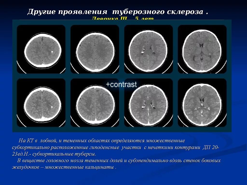 Туберкулезный склероз. Туберозный склероз кт головного мозга. тубулярный склероз головного мозга. туберкулезный склероз головного мозга. туберозный склероз головного мозга мрт.
