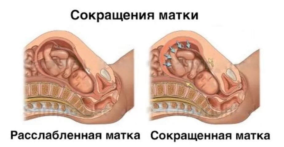 При беременности ощущается матка. Тонус матки при беременности. Беременность матка в тонусе.