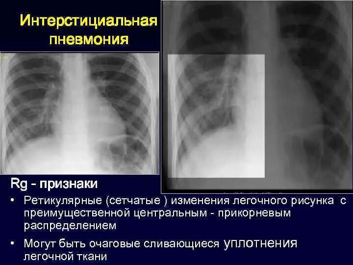 Изменение в легких у ребенка