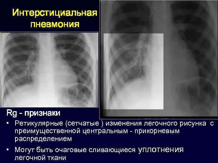 Интерстициальная пневмония рентген. Интерстициальная пневмония рентгенологические признаки. Рентген картина интерстициальной пневмонии. Неспецифическая интерстициальная пневмония рентген. Интерстициальные изменения в легких что это