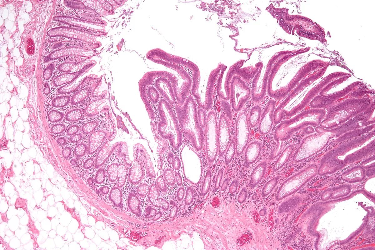 Тубулярная аденома толстой. Тубулярная аденома толстой кишки гистология. Аденома толстой кишки микропрепарат. Аденома толстой кишки гистология. Тубуло-ворсинчатая аденома толстой кишки.