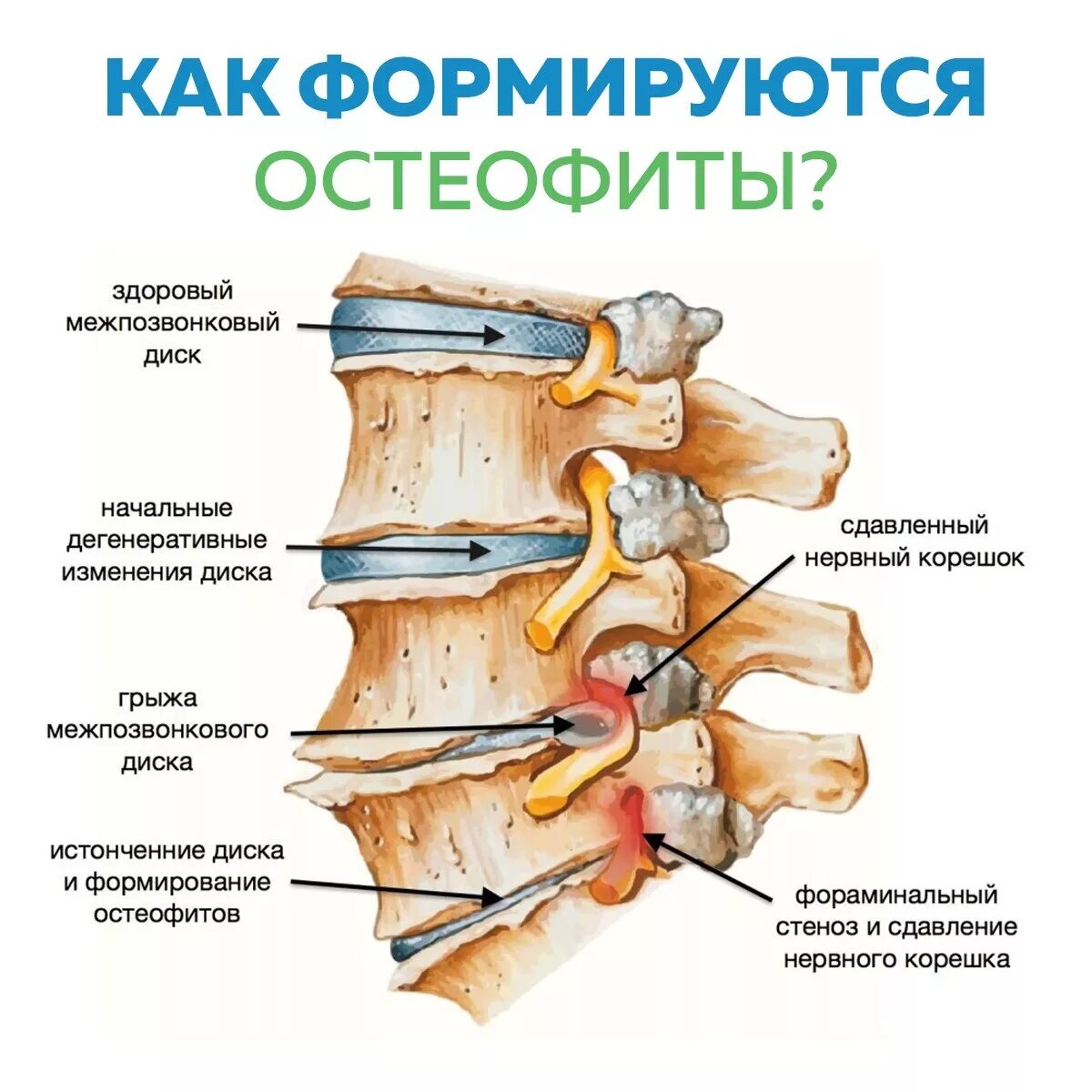 Грыжа с3