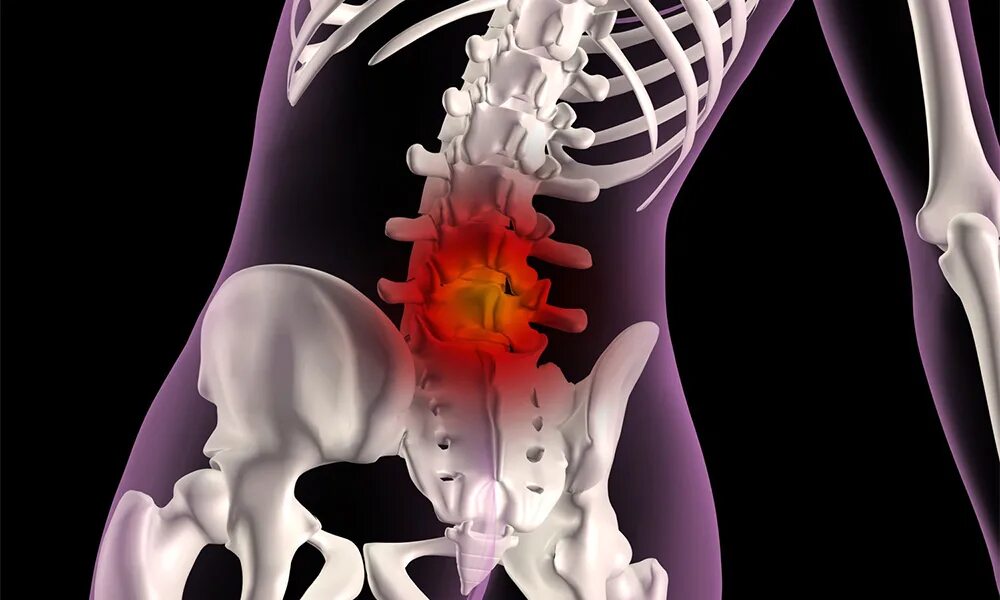 грыжи межпозвонковых дисков l2-l3, l3-l4, l4-l5. грыжа диска l4-l5. межпозвонковый диск l5-s1. позвоночник l4 l5 протрузия. грыжа протрузия l5-s1 позвоночника.