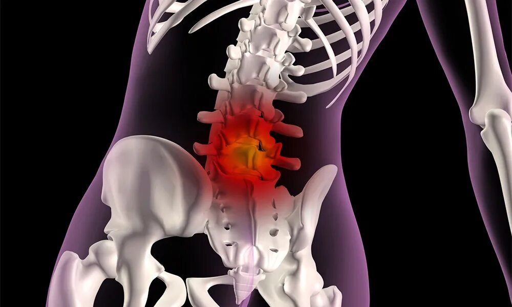 Грыжа поясничного отдела лечение у мужчин симптомы. Протрузии l4 l5. Протрузия l4-l5. Протрузия l4 l5 s1 пояснично-крестцового отдела. Пояснично-крестцовый радикулопатия l 5 s1.