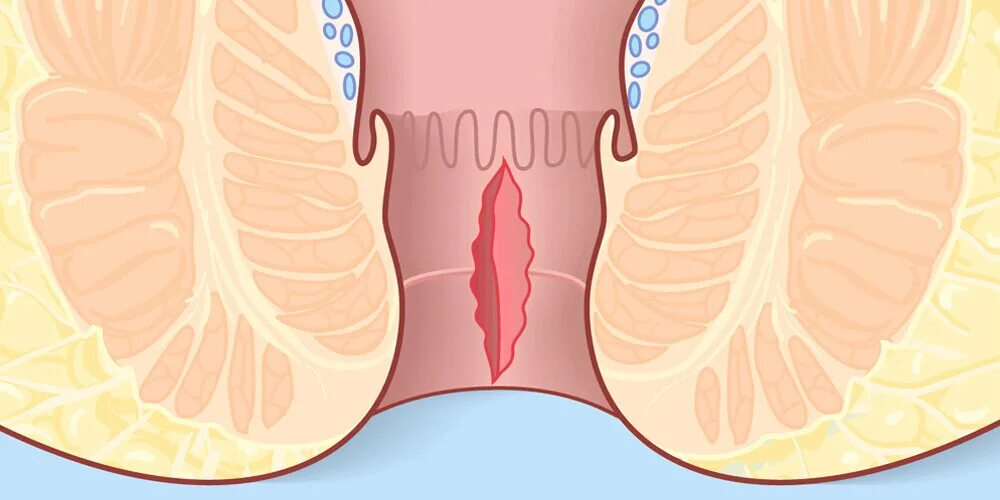 Проктолог трещины. Хроническая анальная трещина. Хроническая трещина ануса. Анальная трещина анатомия.