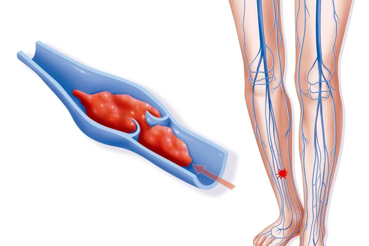 Тромбы в сосудах причины