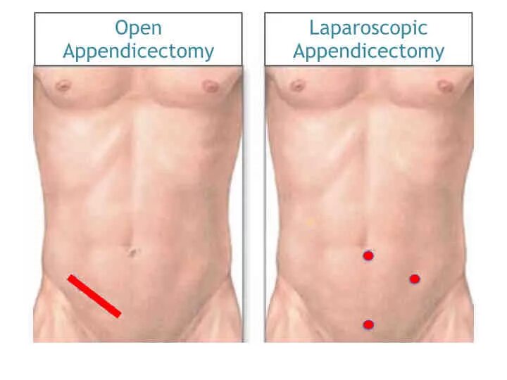 Аппендицит сколько в больнице после операции. Лапаротомия аппендэктомия. Лапароскопия кисты шрамы. Операция аппендицит лапароскопически. Лапароскопия аппендицита.