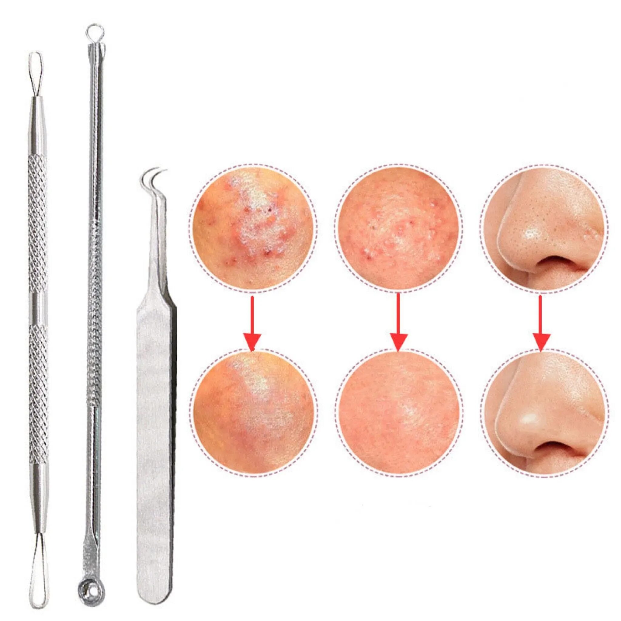 Как называется выдавливание прыщей. Экстрактор угрей и прыщей. Инструменты для удаления угрей,прыщей и комедонов.