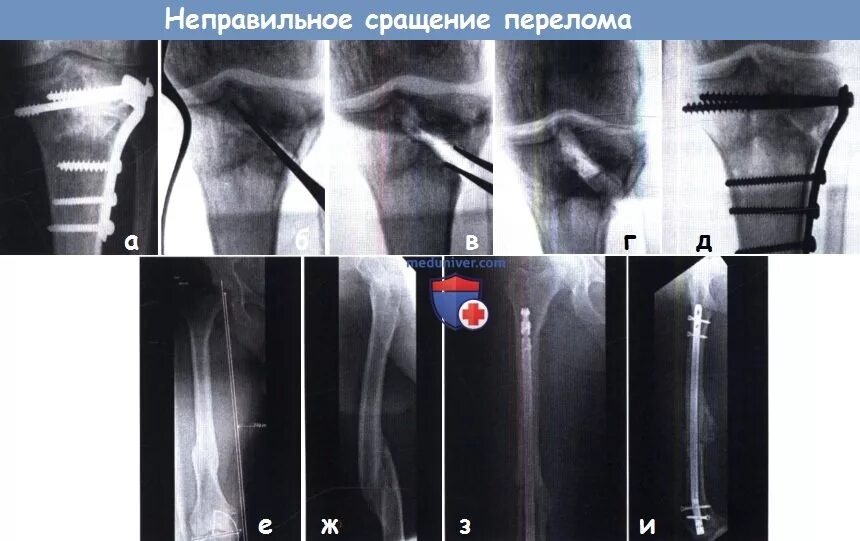 Сколько срастается трещина. Неправильное сращение перелома. Неправильно сросшийся перелом. Вторичное сращение перелома.