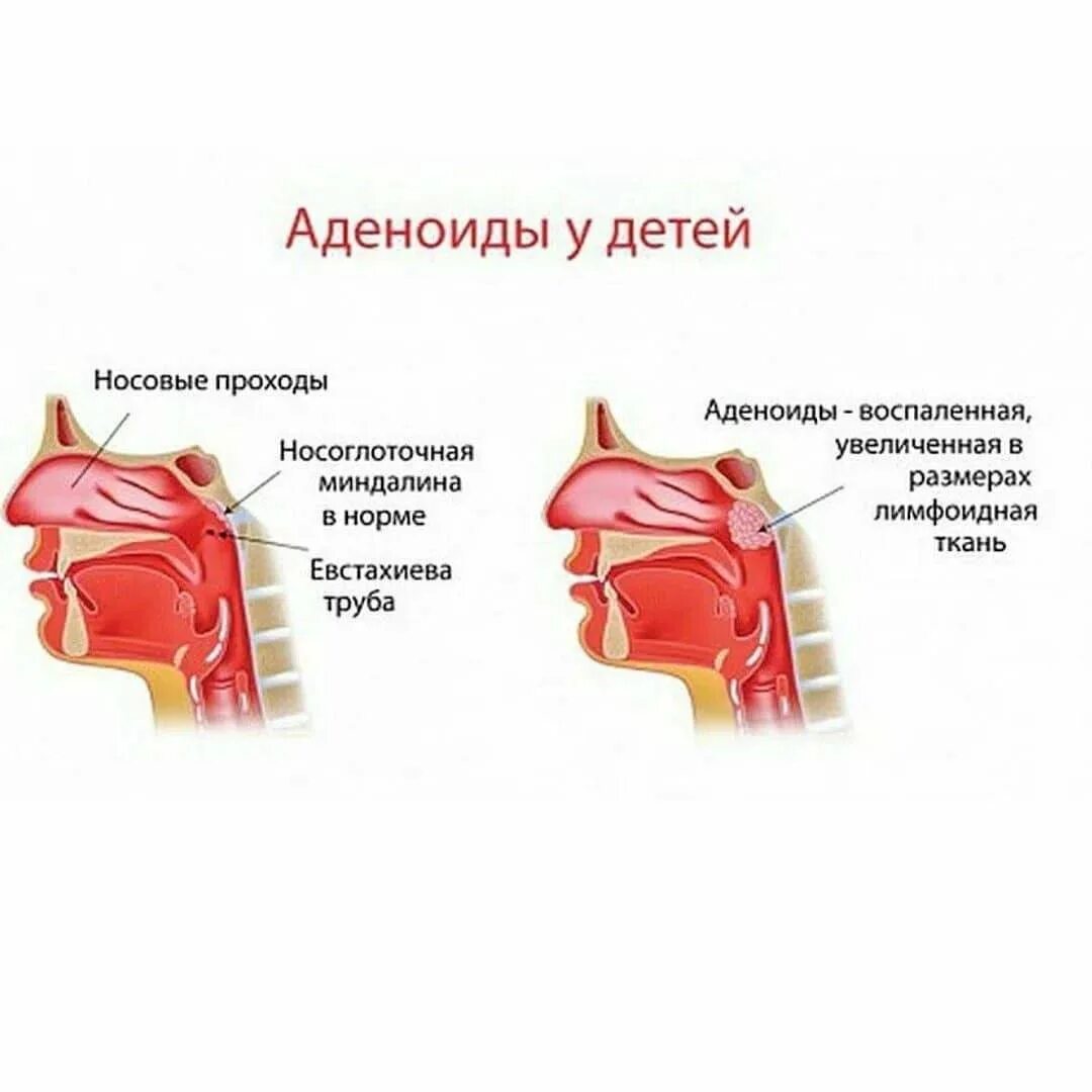 Как лечить аденоиды у ребенка 5. Носоглотка воспаление аденоиды. симптомы при аденоидов к детей. аденоиды 3 степени схема. аденоиды аденоидные вегетации 2 степени.