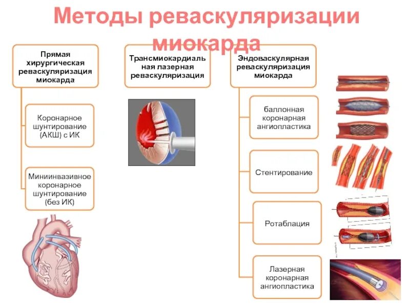 Хирургические методы реваскуляризации миокарда при ИБС. Реваскуляризация коронарных сосудов. Ишемическая болезнь сердца методы реваскуляризации. Баллонная ангиопластика сосудов сердца. Стентирование сосудов последствия