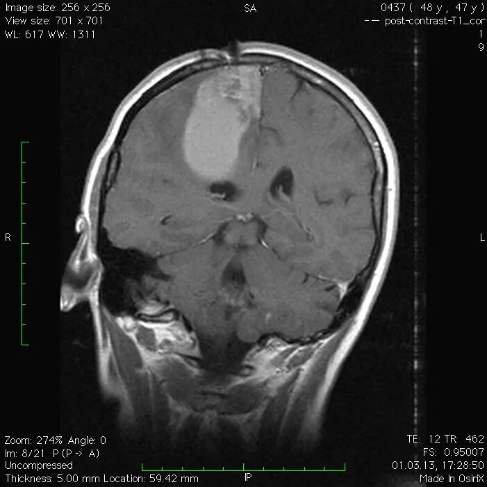 Кистозные метастазы головного мозга кт. Метастазы в головном мозге на мрт с контрастом. Метастазы головного мозга МСКТ. Кистозные метастазы головного мозга мрт.