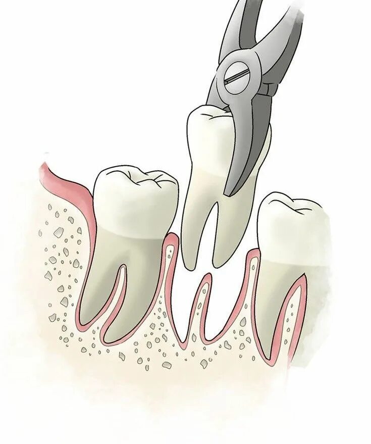 Tooth extraction