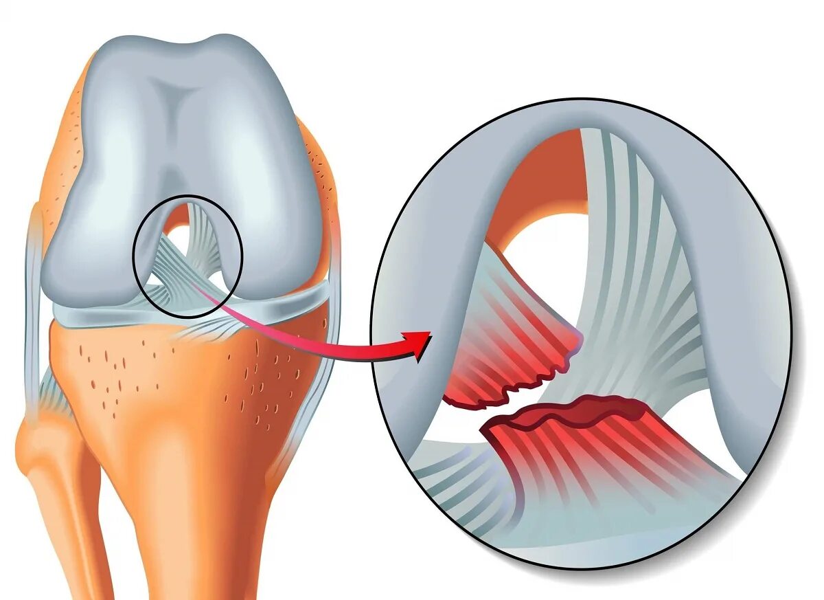 Разрыв крестообразной связки. Связки менисков. Разрыв связок коленного сустава. Разрыв передней крестообразной связки. Полный разрыв передней крестообразной