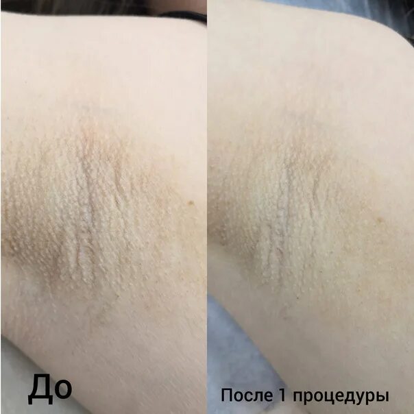 Отбеливание интимных зон до и после. Тилинг для интимной зоны. Осветление интимных зон до и после. Высвктление интимной зоны. Отбеливание интимных зон до и после.