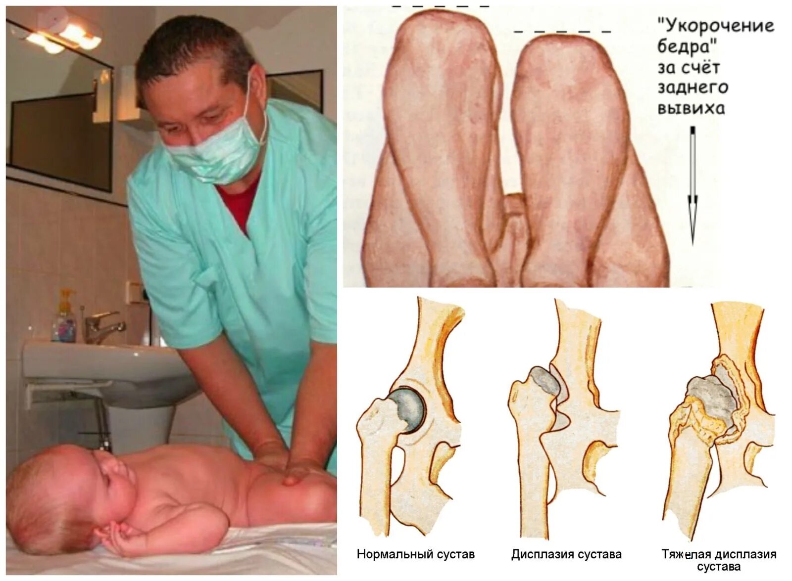 Укорочение трубчатых костей. Дисплазия тазобедренных суставов мкб 10 у новорожденных. Дисплазия вывих тазобедренного сустава. Врождённая дисплазия ТБС. Дисплазия тазобедренных суставов 3ст.