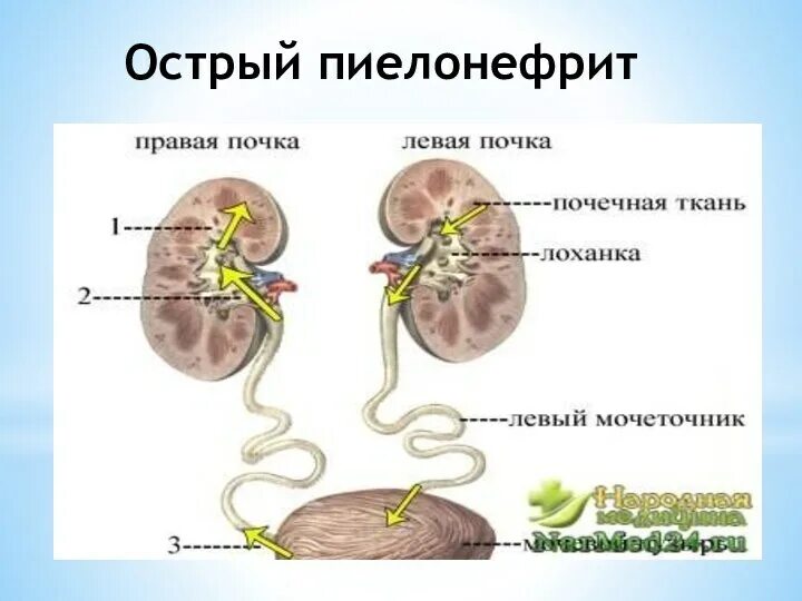 Острый гематогенный Гнойный пиелонефрит. Острый левосторонний пиелонефрит. Строение почки при пиелонефрите.