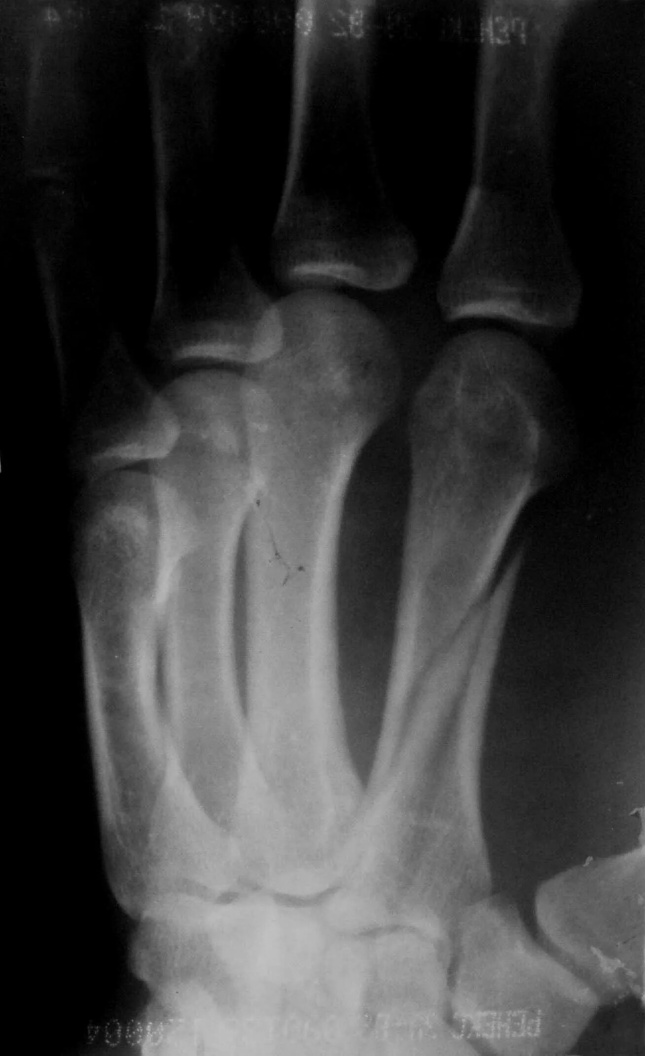 перелом проксимальной фаланги 1 пястной кости. рентген кисти перелом пястной кости. перелом 3 запястной кости. перелом второй пястной кости остеосинтез. перелом 2 пястной кости.