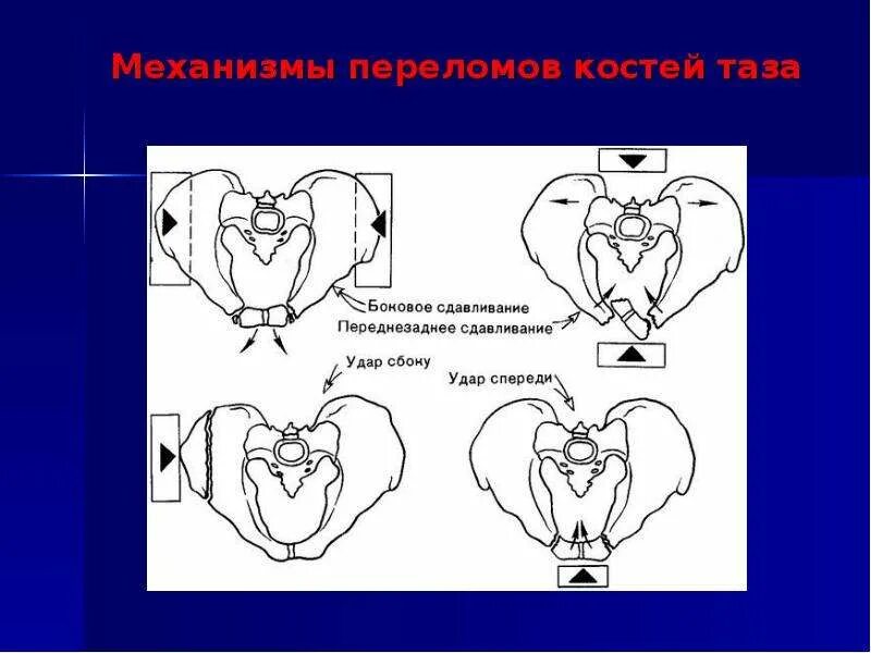 Перелом мальгеня и вуалемье. Перелом костей таза первая помощь алгоритм. Переломы таза с нарушением целостности тазового кольца. Классификация переломов тазового кольца. При переломе позвоночника и костей таза возникает паралич чего.