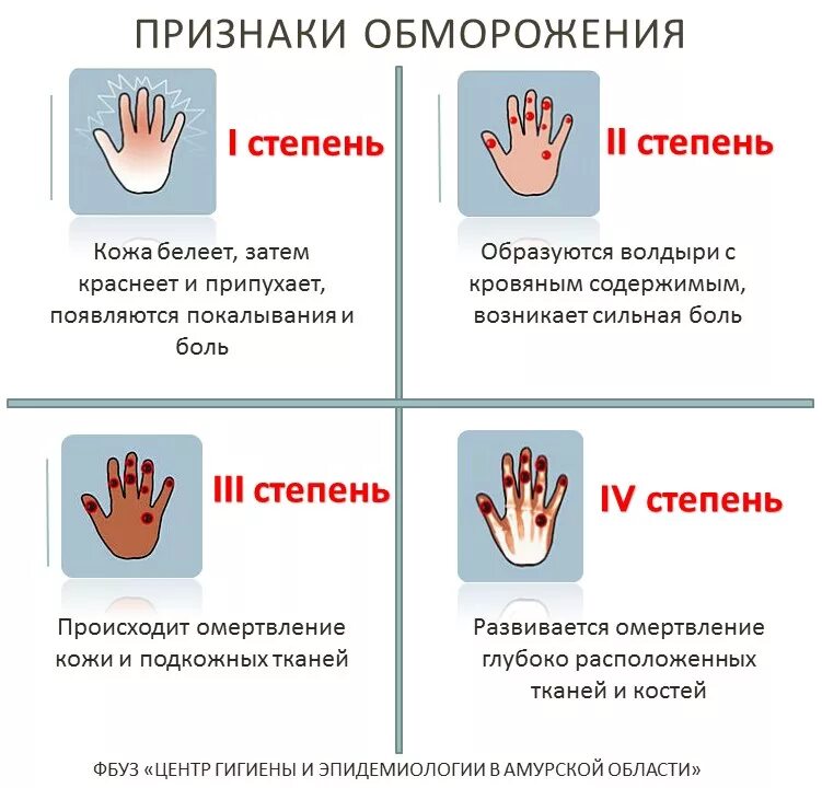 Характерный признак отморожения III степени. Обморожение 1 степени симптомы. Обморожение 1 2 3 степени. Характерный признак обморожения 2 степени.