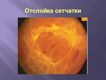 Отслойка сетчатки причины и последствия