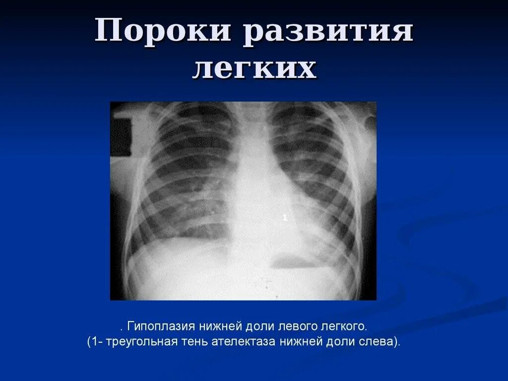 Порок легкого у ребенка. Врожденные пороки органов дыхания. Врожденная локализованная эмфизема. Пороки развития органов дыхания. Пороки развития бронхов.