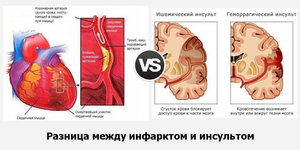 Чем отличается инфаркт от инсульта простыми. Инсульт и инфаркт головного мозга отличия. Инсульт сердца инфаркт сердца. Разница между инсультом и инфарктом головного мозга. Симптомы инсульта и инфаркта различия.