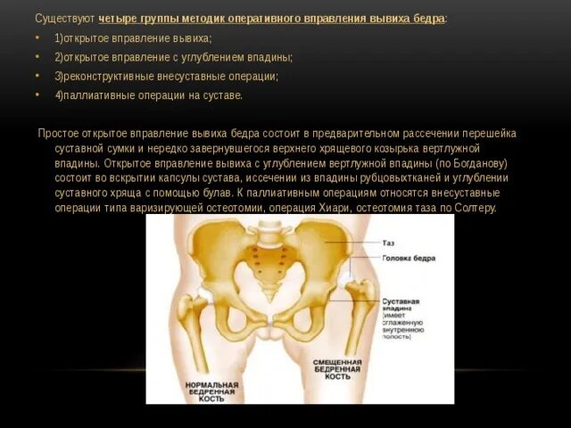 Вывих бедра тест. Операция хиари тазобедренного сустава. открытое вправление врожденного вывиха бедра. врожденный вывих бедра операция. четыре группы методик оперативного вправления вывиха бедра.
