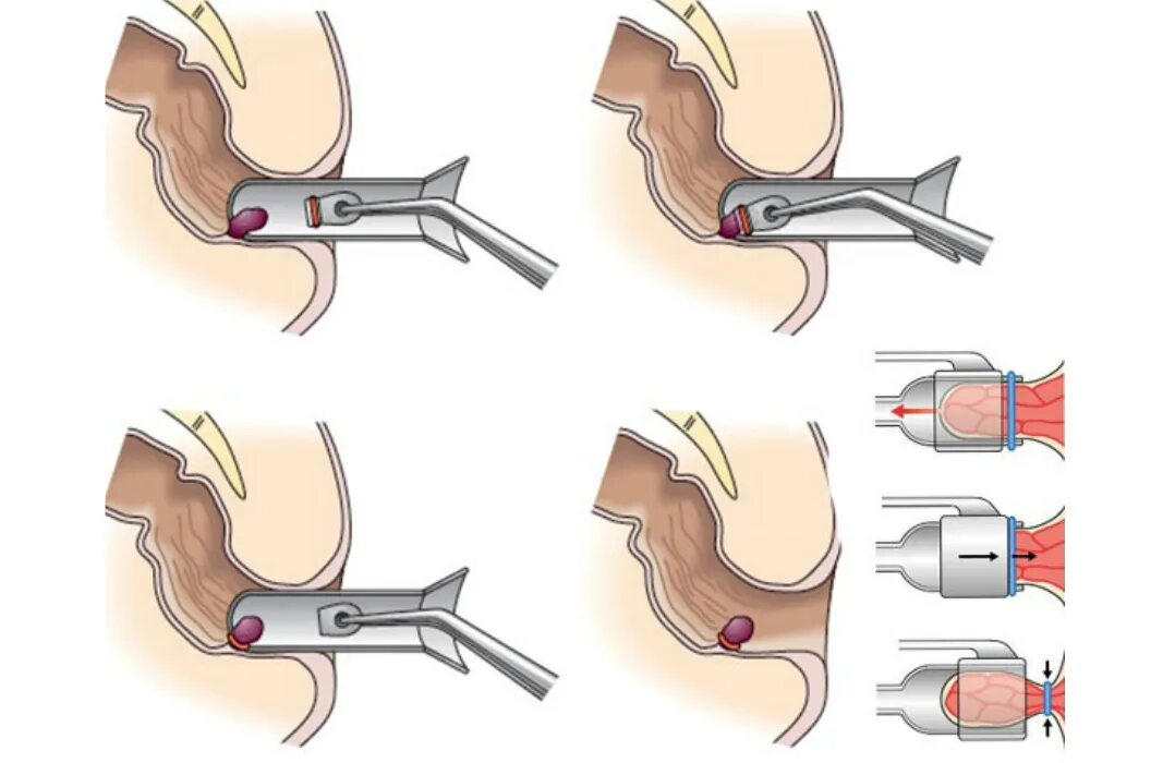 Вакуумное лигирование латексными кольцами. Перевязка геморроидальных узлов. Латексное лигирование геморроидальных узлов. Лигирование геморроидальных узлов (1 узел). Геморрой влияет на потенцию