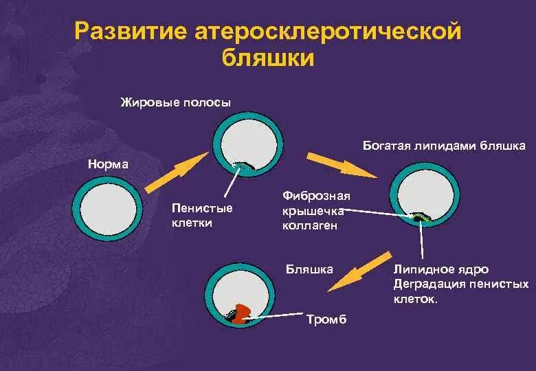 Образование атеросклеротической бляшки. Механизм формирования атеросклеротической бляшки. стадии развития атеросклеротической бляшки. стадии развития бляшки. схема образования атеросклеротической бляшки.