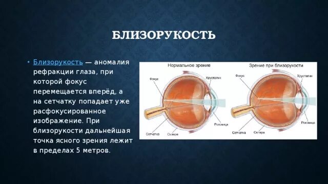Точка лежащая зрение. Миопия рефракция. Аномалии рефракции близорукость. Рефракция при миопии. Фокус глаза при близорукости.