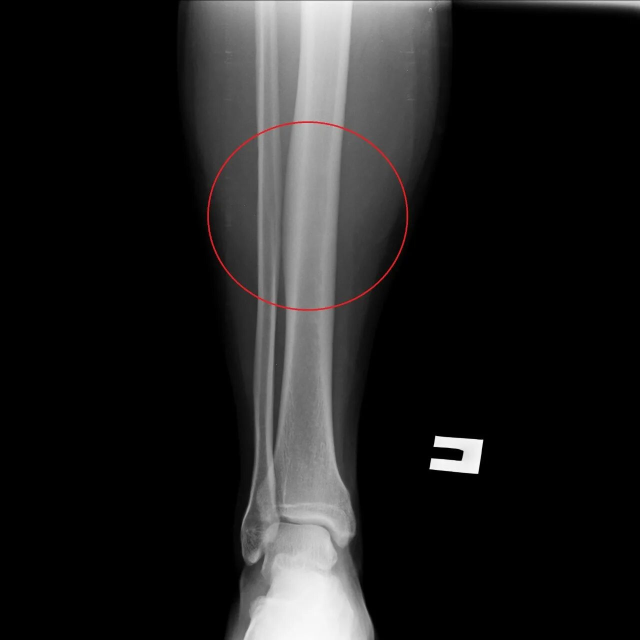 Трещина большеберцовой кости рентген. Перелом большеберцовой кости рентген. Большеберцовая кость рентген. Рентген большеберцовой кости норма.