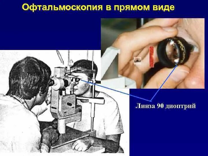 Линза для осмотра глазного дна. Офтальмоскопия глазного дна. Прямая офтальмоскопия глазного дна. Осмотр глазного дна с линзой Гольдмана. Офтальмоскопия линзой