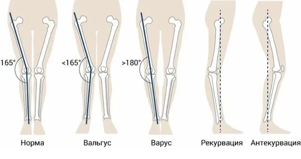 Развитие нижней конечности. Варусная деформация коленного сустава оси. Вальгусная деформация искривление стопы. Dfhecyfz ltajhvfwbz JCB rjytxyjcnb. Варус вальгусная деформация.