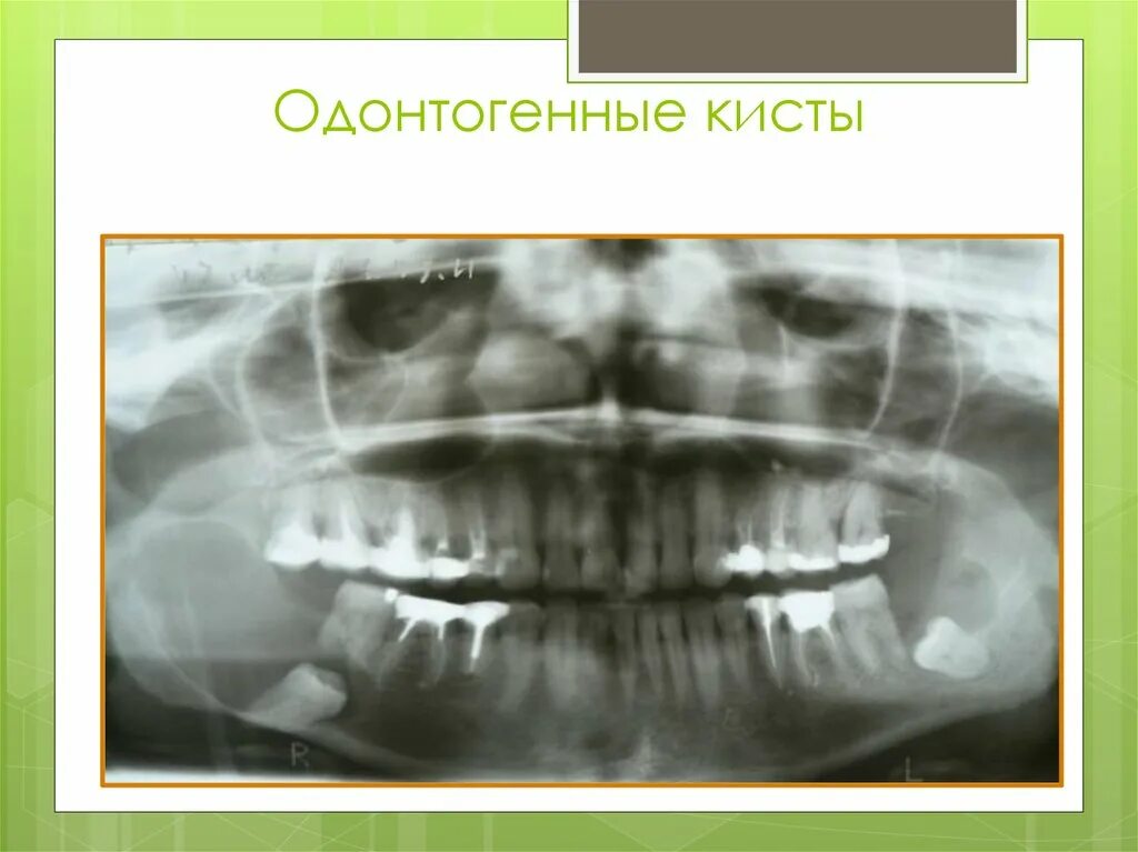 Опухоли челюстей классификация. Одонтома нижней челюсти. Патогенез одонтогенного остеомиелита. Взаимосвязь одонтогенной инфекции с общей патологией. Одонтогенной инфекции.