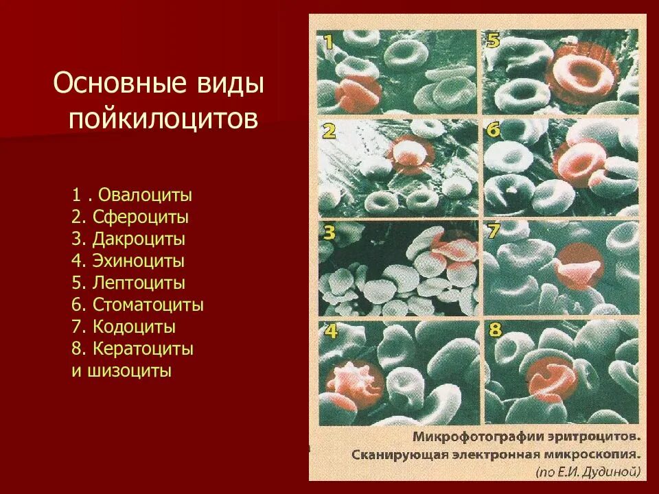 Эхиноциты эритроциты. Сфероциты овалоциты. Сфероциты, планоциты, эхиноциты,. Стоматоциты в крови.