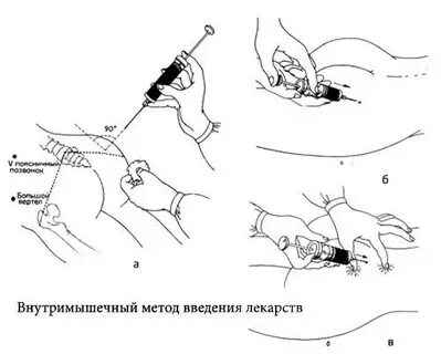 Стандартная процедура внутримышечная инъекция