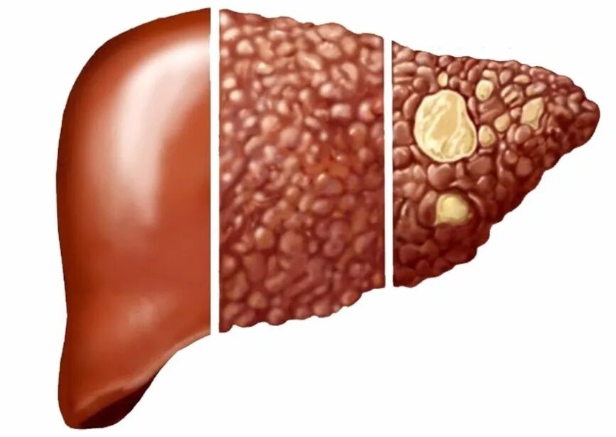 Сухой печени. Гепатитный цирроз печени. Алкогольный гепатит и цирроз. Цирроз печени анатомия.