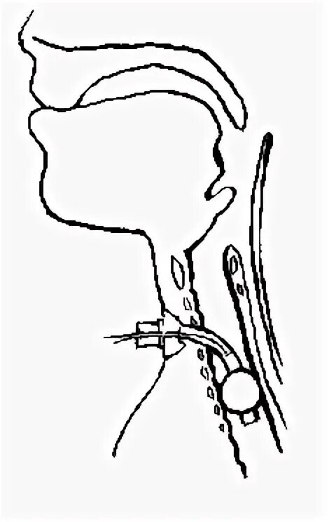 Санация трахеостомы алгоритм. E[Jl PF трахеостомой. Уходалглритм за трахеостомой. Уход за трахеостома. Уход за трахеостомой сестринское дело