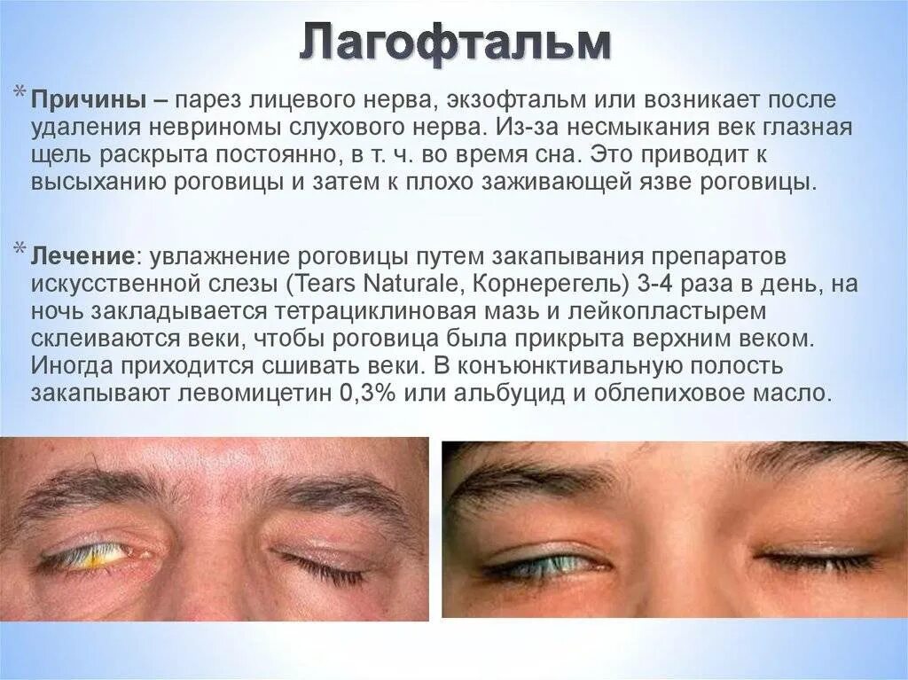 Симптоматика лагофтальма. Неврит лицевого нерва глаза