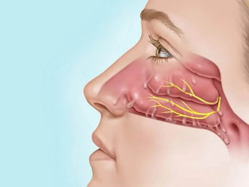 Острый катаральный ринит. Аллергический ринит слизистая носа. Воспаление слизистой носа. Запах железа носу железы