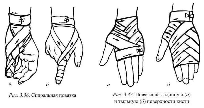 Восьмиобразная повязка на лучезапястный сустав. Техника наложения повязки варежка. Наложение восьмиобразной повязки на лучезапястный сустав алгоритм. Наложение давящей повязки на шею. Бинтование предплечья эластичным бинтом.