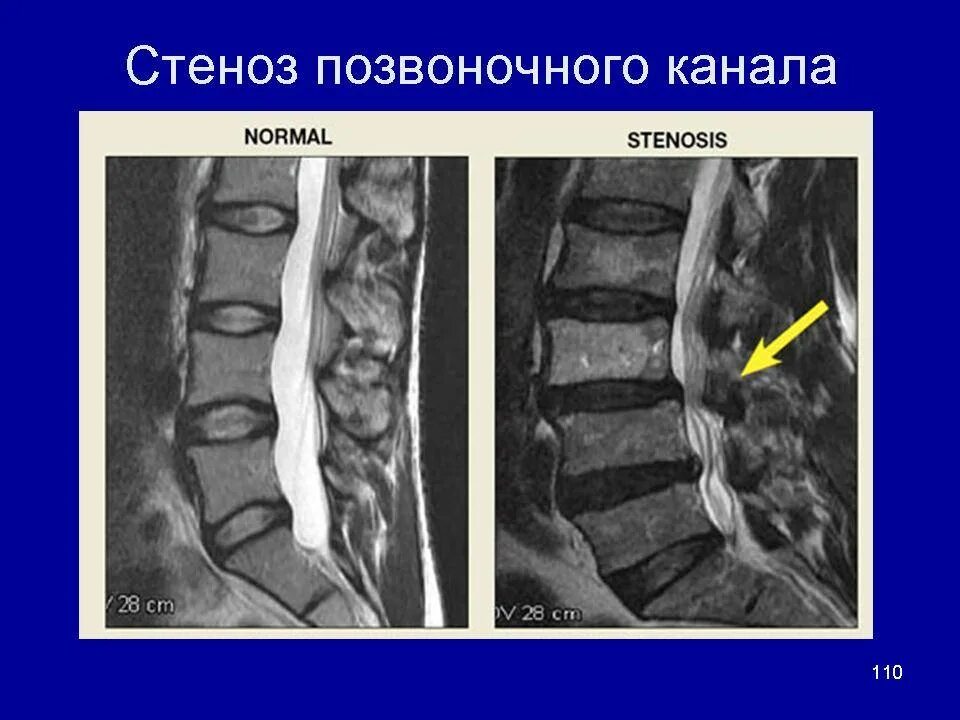 Как лечить стеноз шеи. Стеноз позвоночного канала с1-с2. стеноз позвоночного канала l2-l3. дегенеративный спинальный стеноз l3-l4. абсолютный стеноз l4/s1.